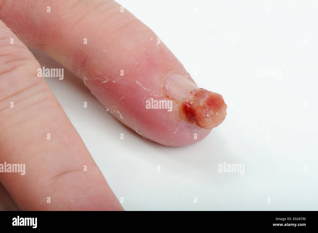 Virusinfektion des kleinen Fingers. Stockfoto