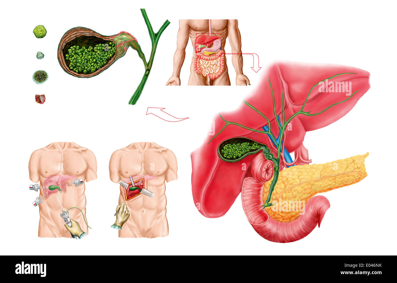 Medizinische Illustration Gallensteine in der Gallenblase und die chirurgische Entfernung der Gallenblase, bekannt als Cholezystektomie zeigen. Stockfoto
