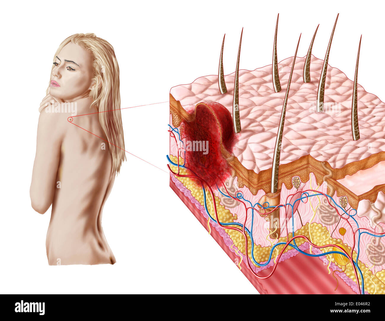Abbildung eines atypischen Wachstums auf der Haut, die Anzeichen von Hautkrebs sein kann. Stockfoto Abbildung eines atypischen Wachstums auf der Haut, die Anzeichen von Hautkrebs sein kann. Stockfoto