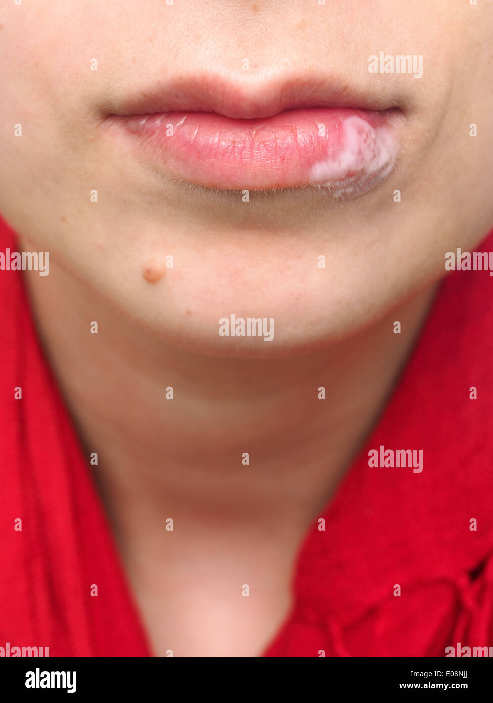 Junge Frau mit Salbe auf Lippe wegen Herpes simplex Stockfoto