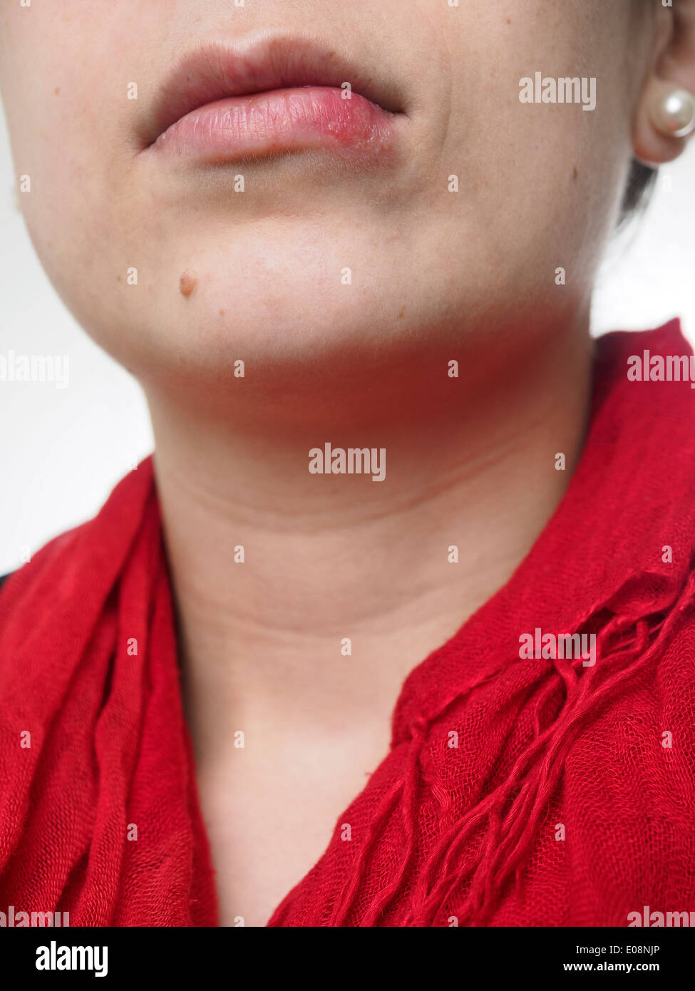 Junge Frau mit Herpes Simplex auf Lippe Stockfoto