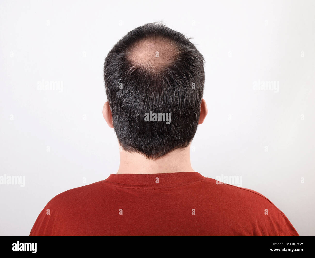 Männerkopf mit schütterem Haar oder Haarausfall Stockfoto