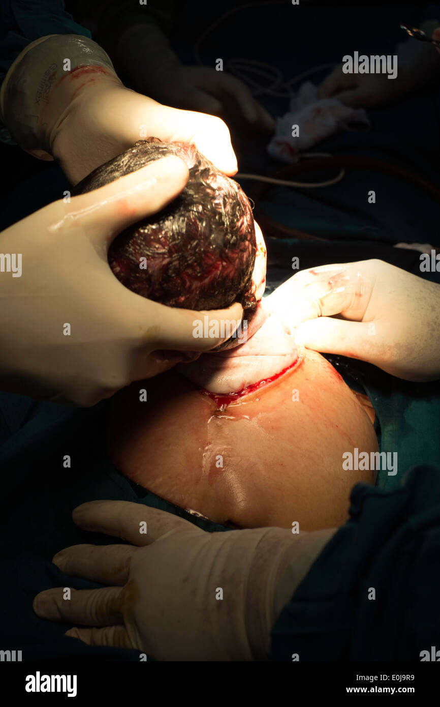 Ärzte und Chirurgen durchführen ein Kaiserschnitt C Abschnitt Betrieb, ein Baby in einem Krankenhaus in Malang Ost Java Indonesien zu liefern Stockfoto