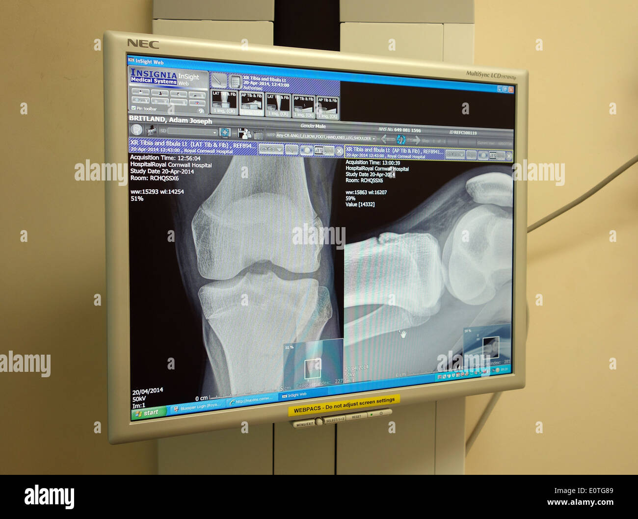 eine Patienten-Xray-Bild auf einem Bildschirm in einem Krankenhaus Beratung Zimmer Stockfoto