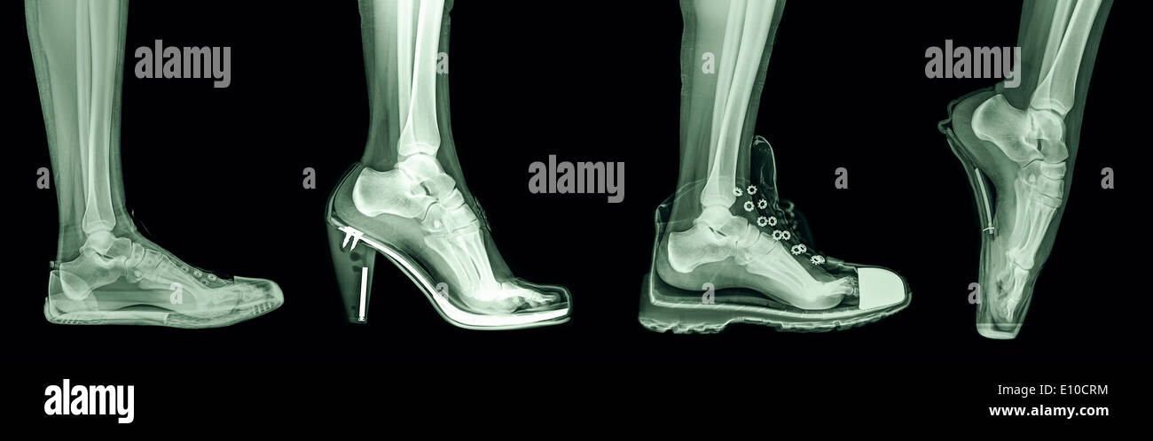 Röntgen des Fußes eine Frau in 4 verschiedene Schuhe (von links nach rechts) Trainer, High Heel, laufen und Ballett Stockfoto
