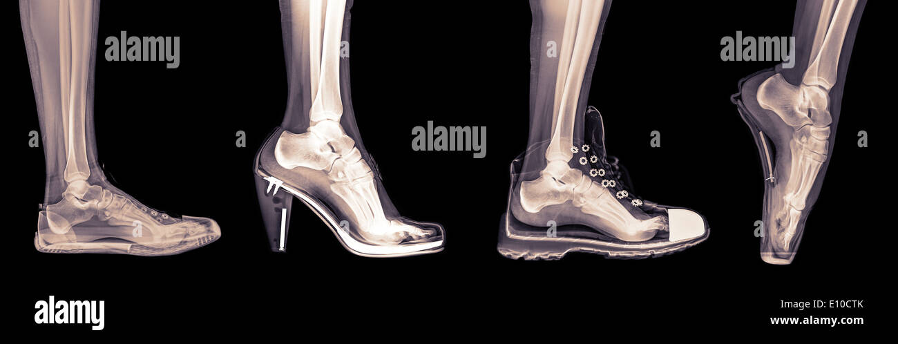 Röntgen des Fußes eine Frau in 4 verschiedene Schuhe (von links nach rechts) Trainer, High Heel, laufen und Ballett Stockfoto