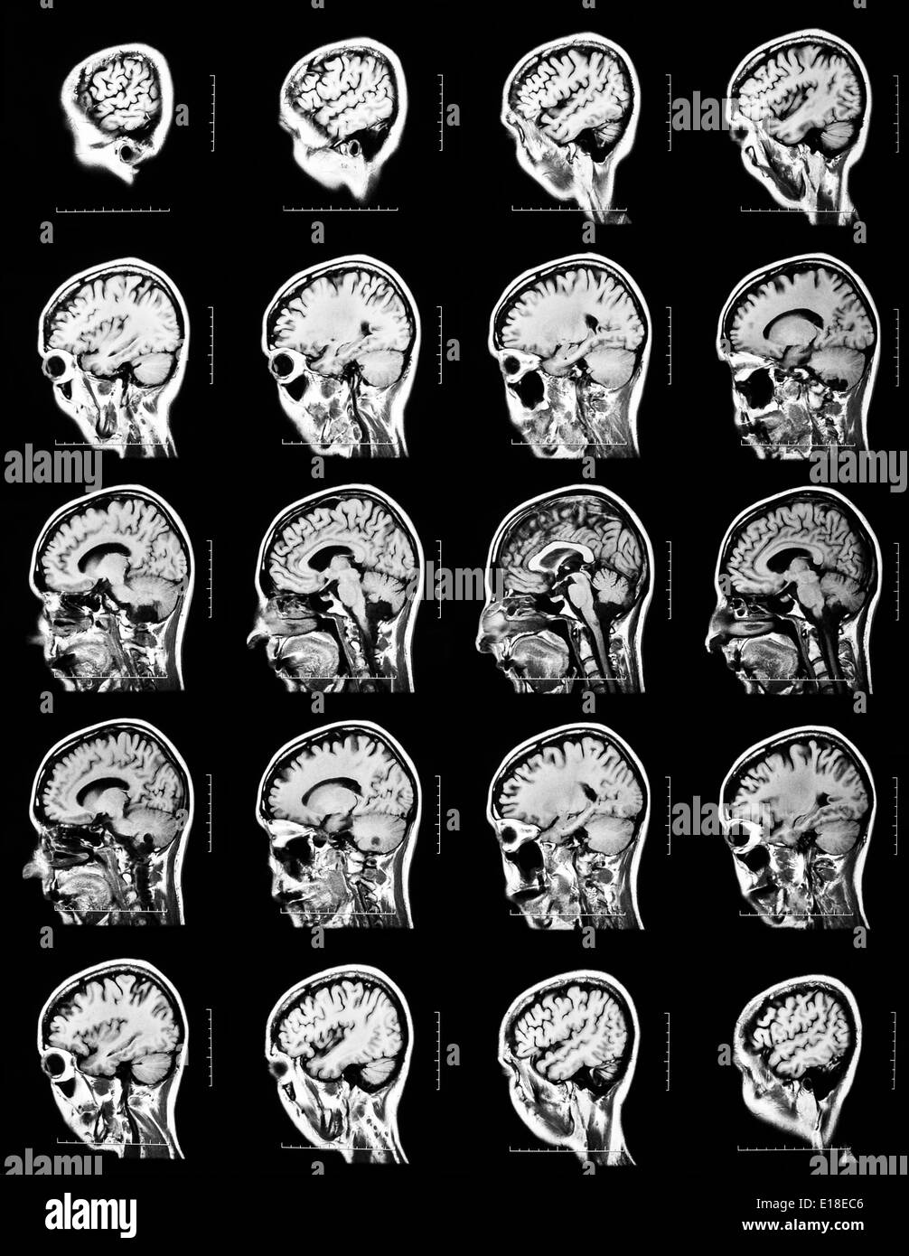 Reihenfolge der vertikalen Abschnitte des menschlichen Gehirns - MRT-Untersuchung Stockfoto