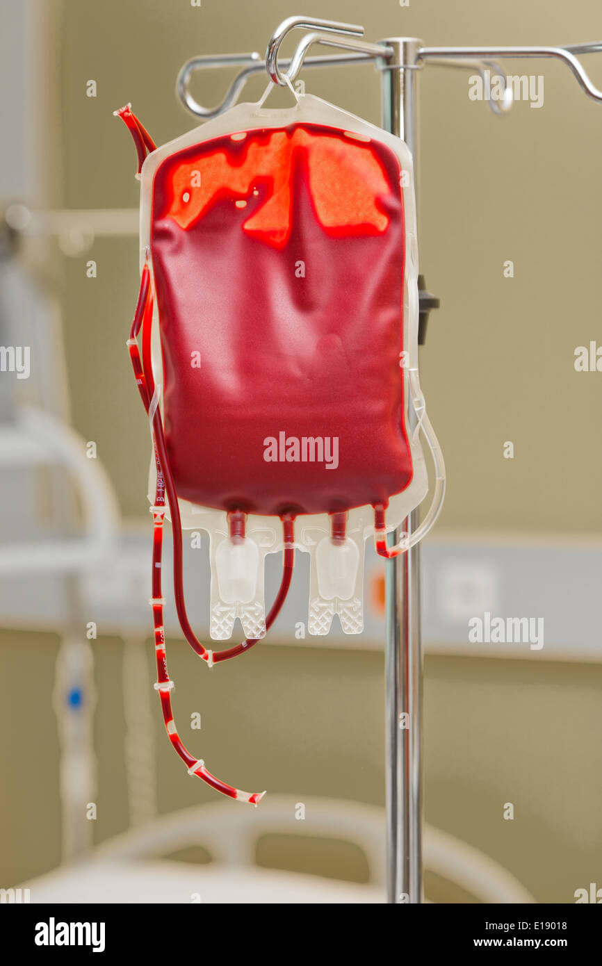 Eine Blutkonserve Zur Infusion in Eine Klinik. Spenderblut Wird Verabreicht. Stockfoto