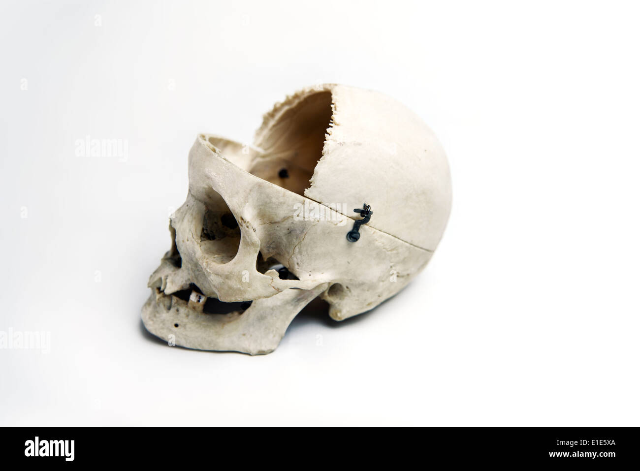 Echte menschliche Schädel mit Trepanation und vorderen Viertel entfernt verwendet für das Medizinstudium Stockfoto