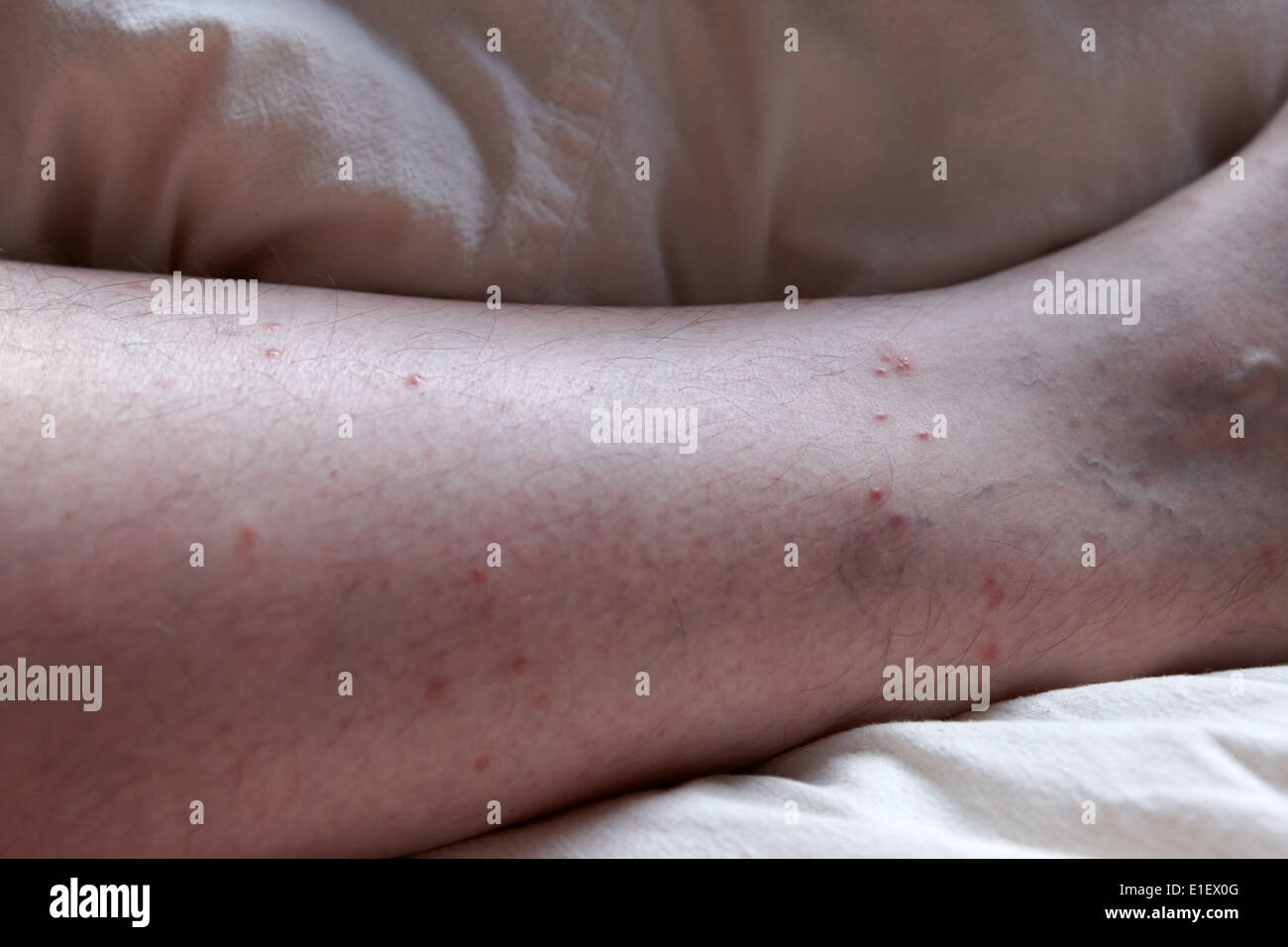 mittleren Alters mans Bein mit floh und Insektenstich Flecken oberhalb Socke Stockfoto