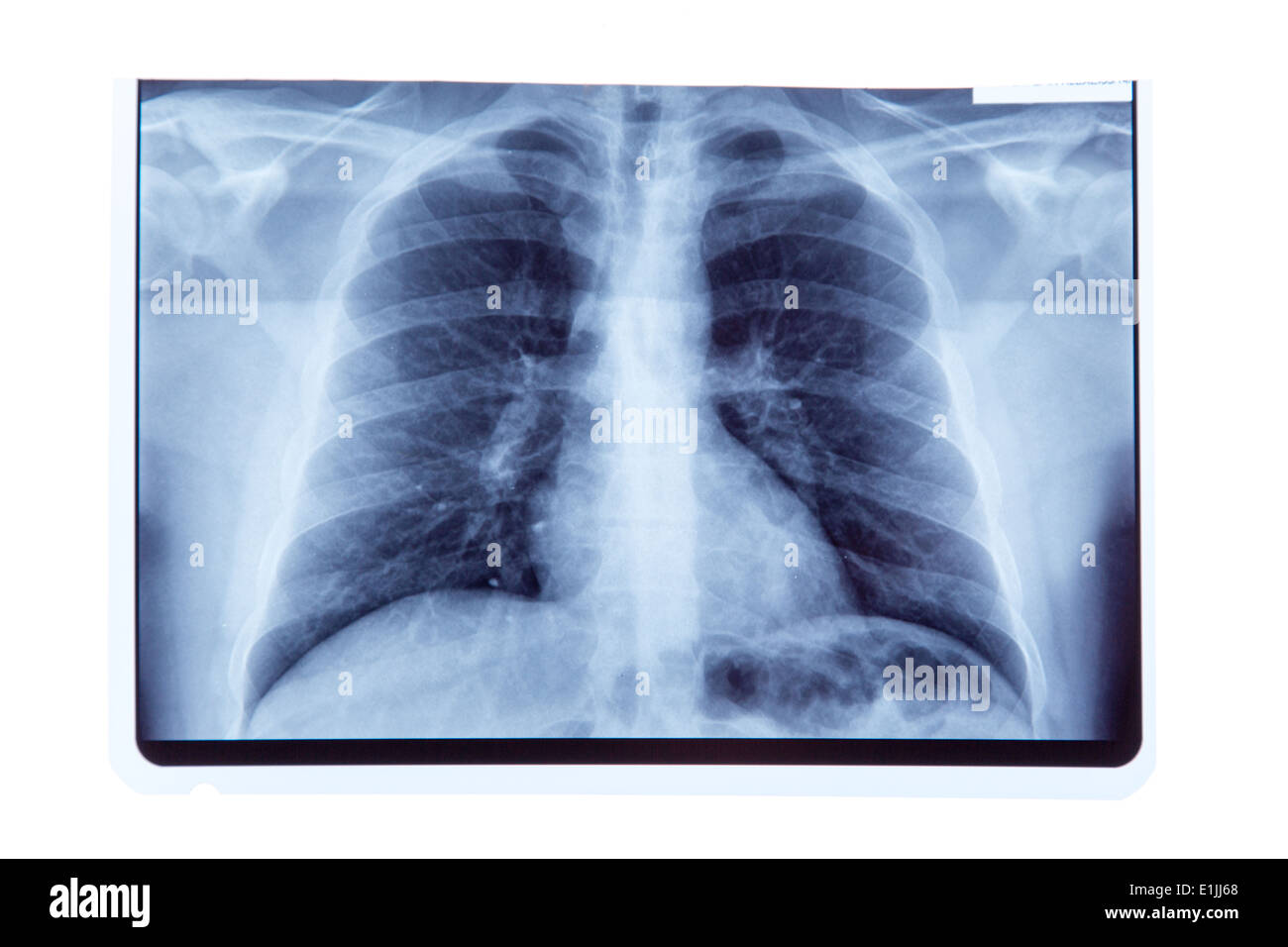 Lunge Röntgen Röntgenergebnis, isoliert auf weißem Hintergrund Stockfoto
