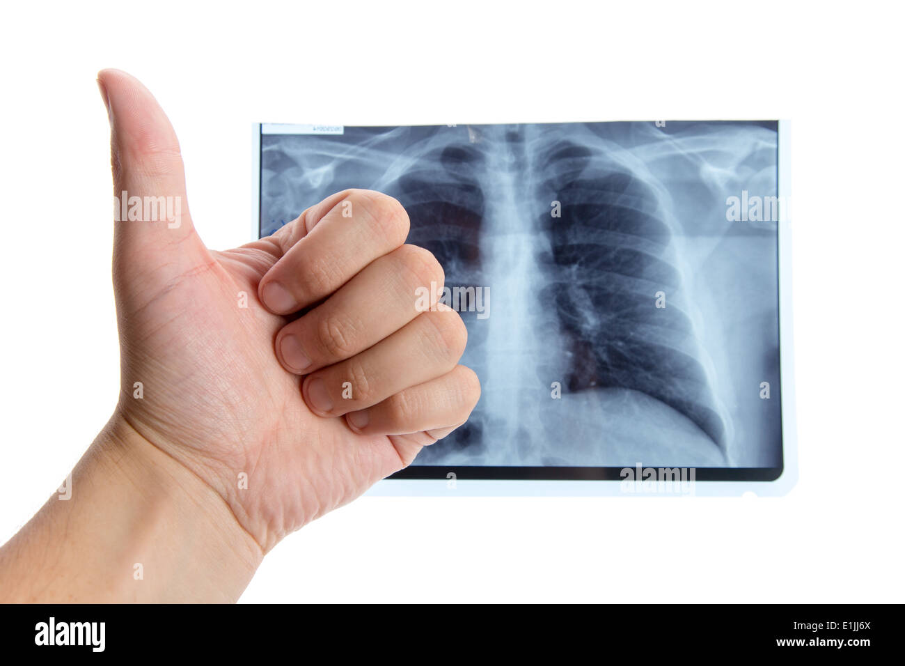 Männliche Hand Daumen neben Lunge Röntgen, isoliert auf weißem Hintergrund auftauchen Stockfoto