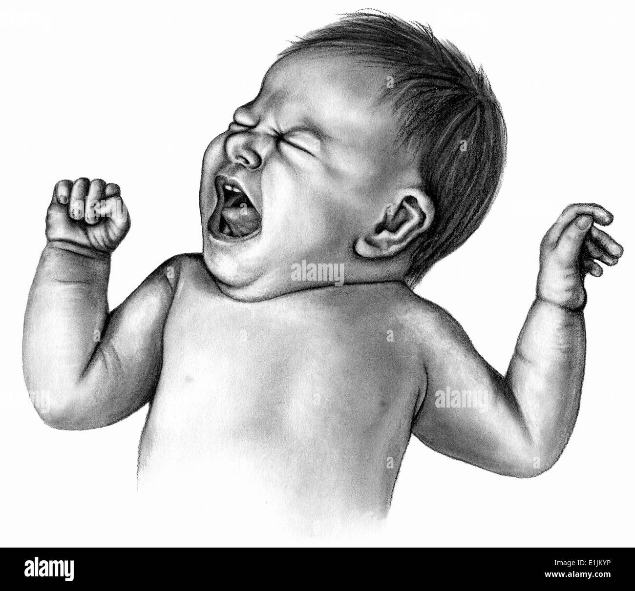 Anhaltende schreien bei Säuglingen führen zu Zyanose (blau-Baby). Stockfoto