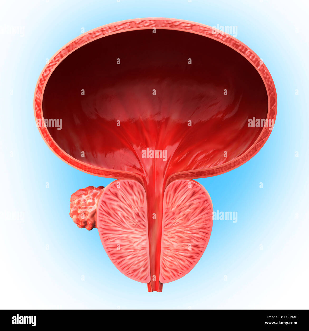 Menschlichen Prostata Tumor Cut-away Computer Artwork. Stockfoto