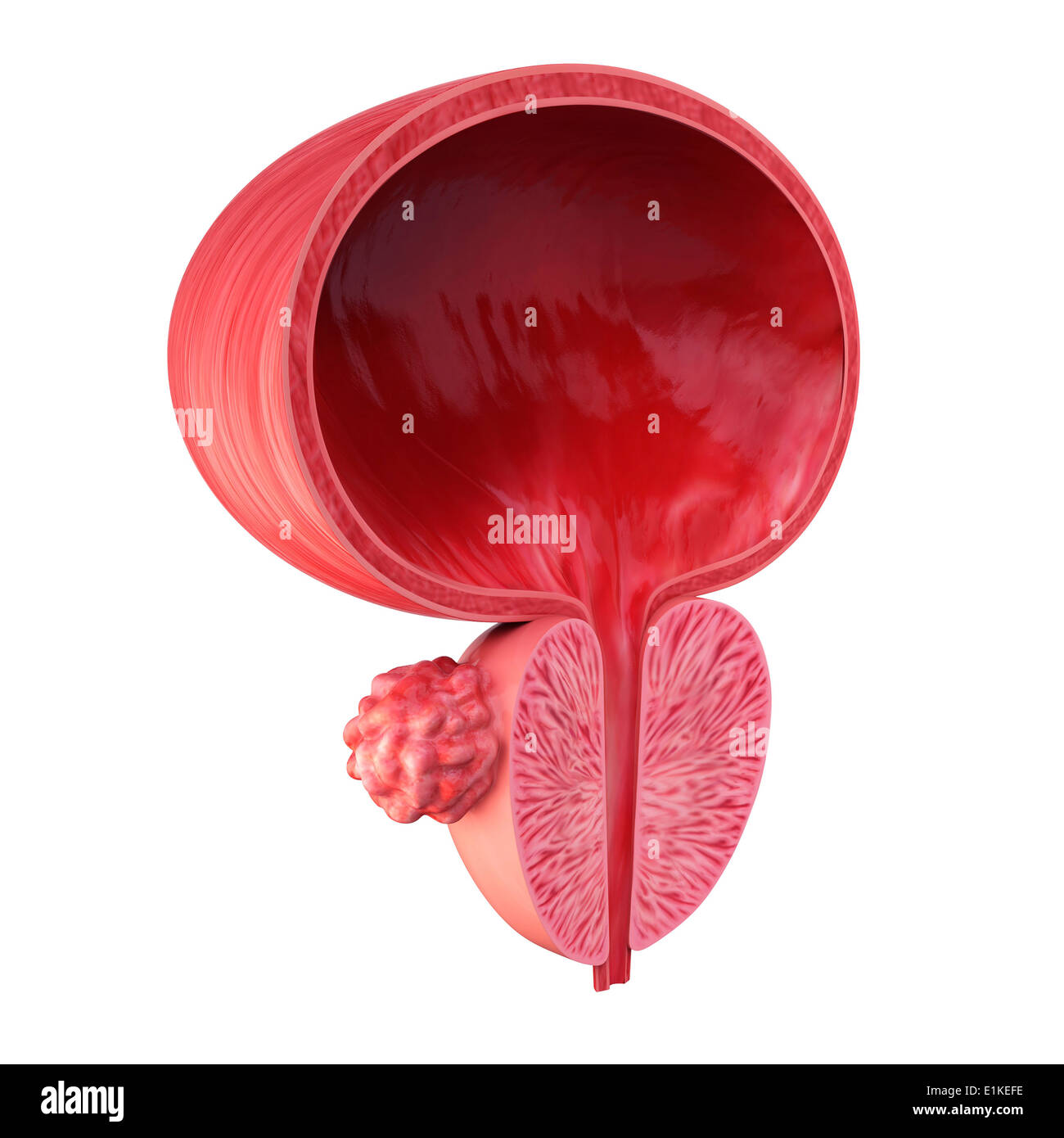 Menschlichen Prostata Tumor Cut-away Computer Artwork. Stockfoto