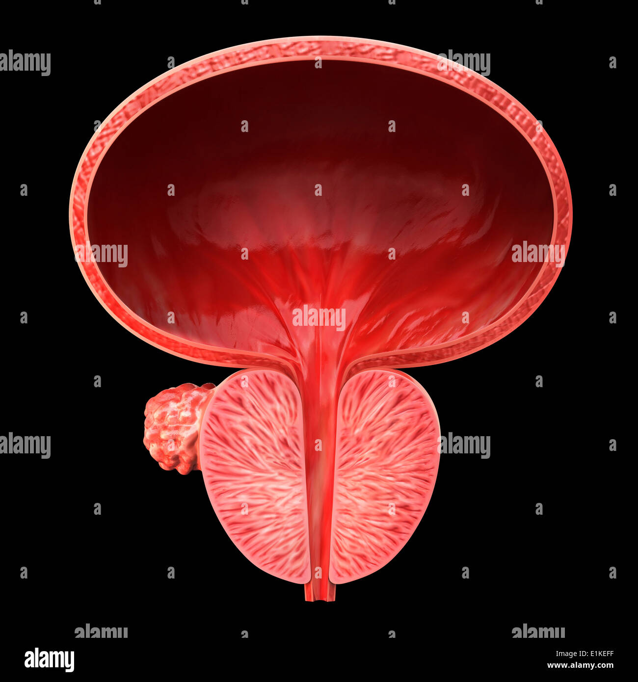 Menschlichen Prostata Tumor Cut-away Computer Artwork. Stockfoto