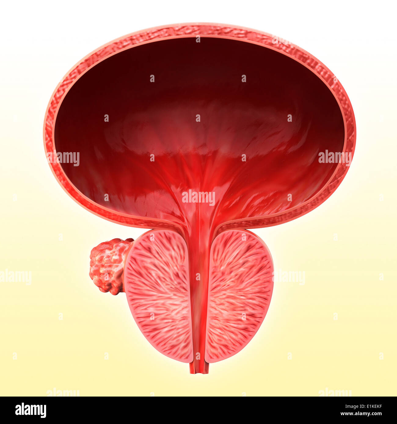 Menschlichen Prostata Tumor Cut-away Computer Artwork. Stockfoto