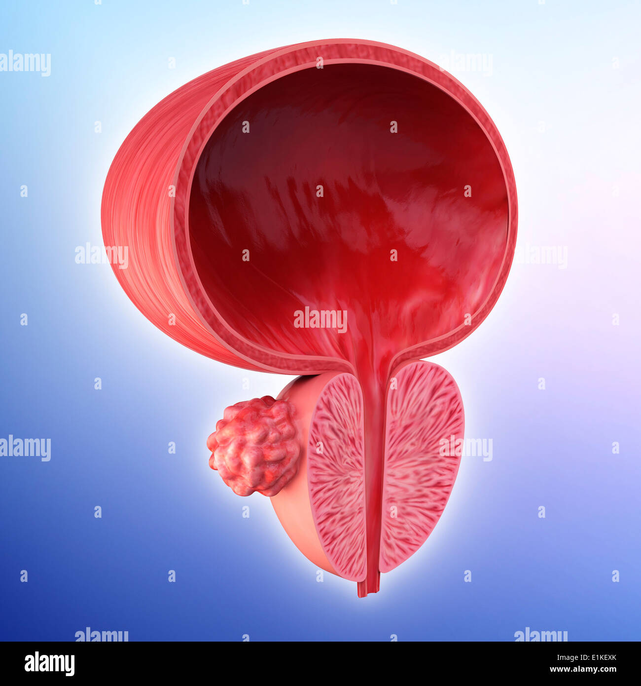 Menschlichen Prostata Tumor Cut-away Computer Artwork. Stockfoto