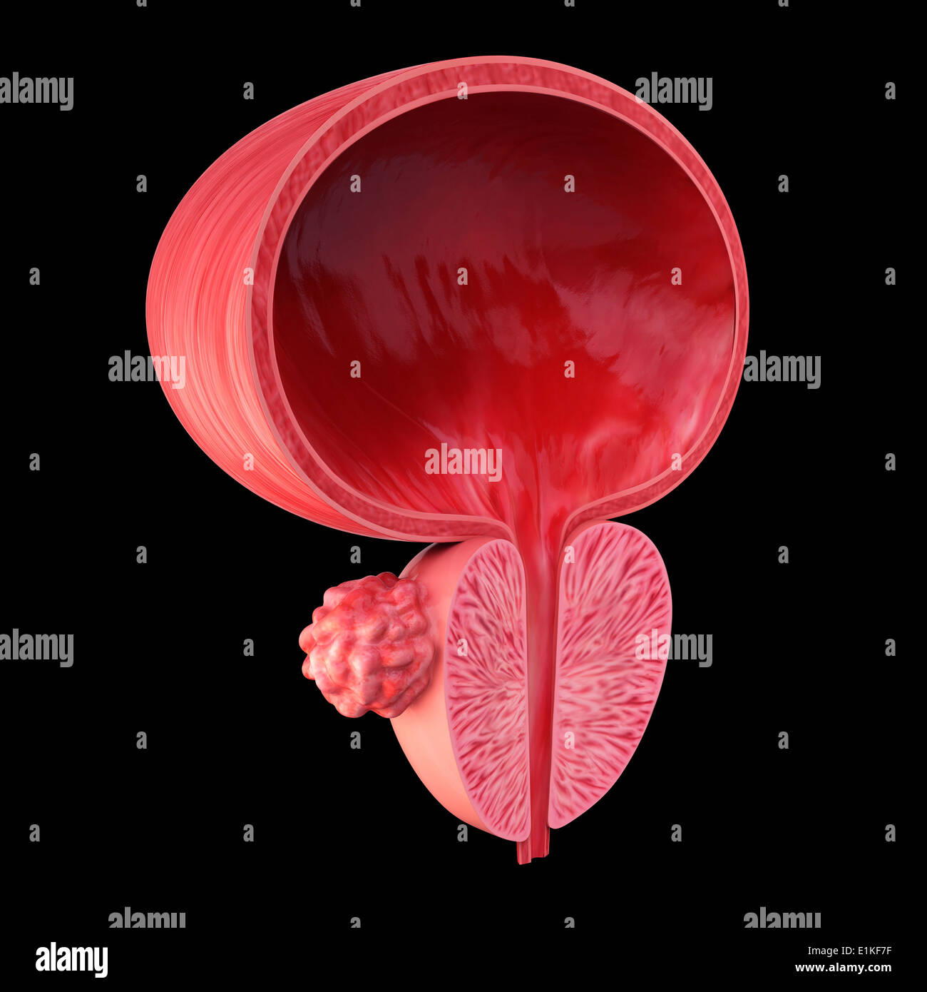 Menschlichen Prostata Tumor Cut-away Computer Artwork. Stockfoto