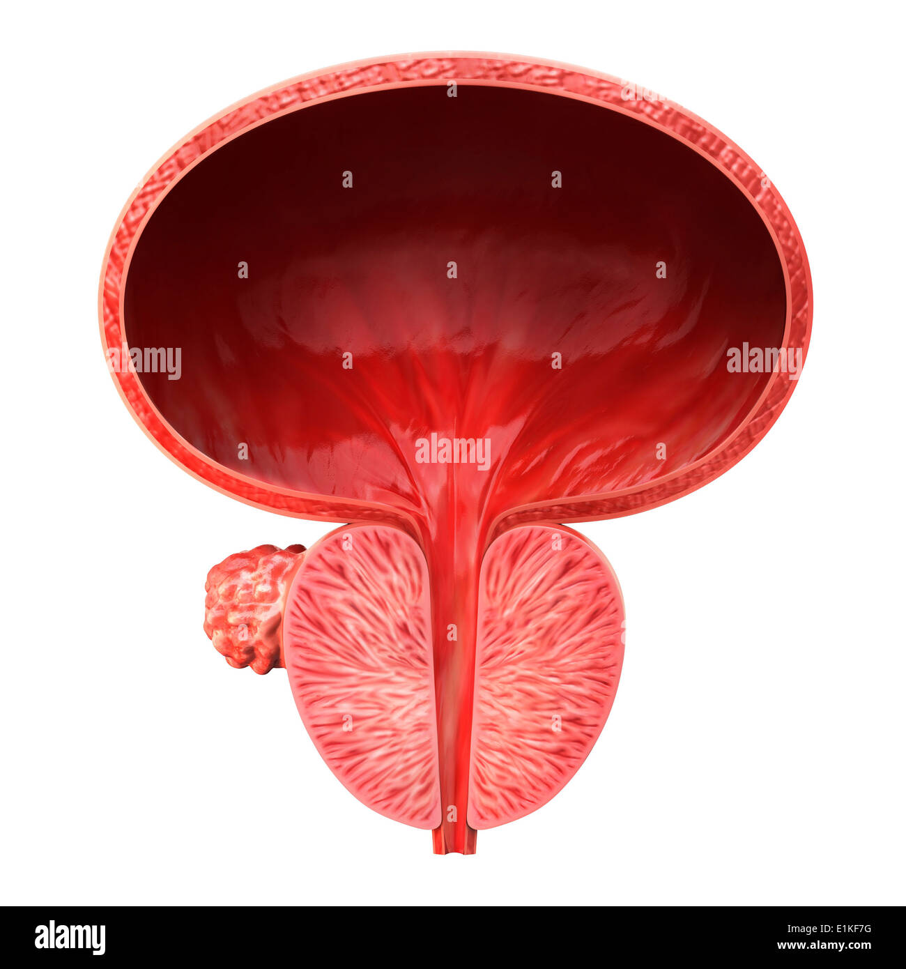 Menschlichen Prostata Tumor Cut-away Computer Artwork. Stockfoto