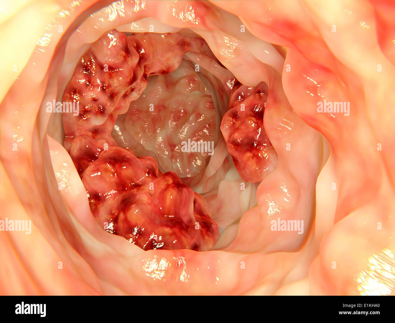 Kunstwerk auf eine endoskopische Bild an Dickdarmkrebs zu erkranken. Stockfoto