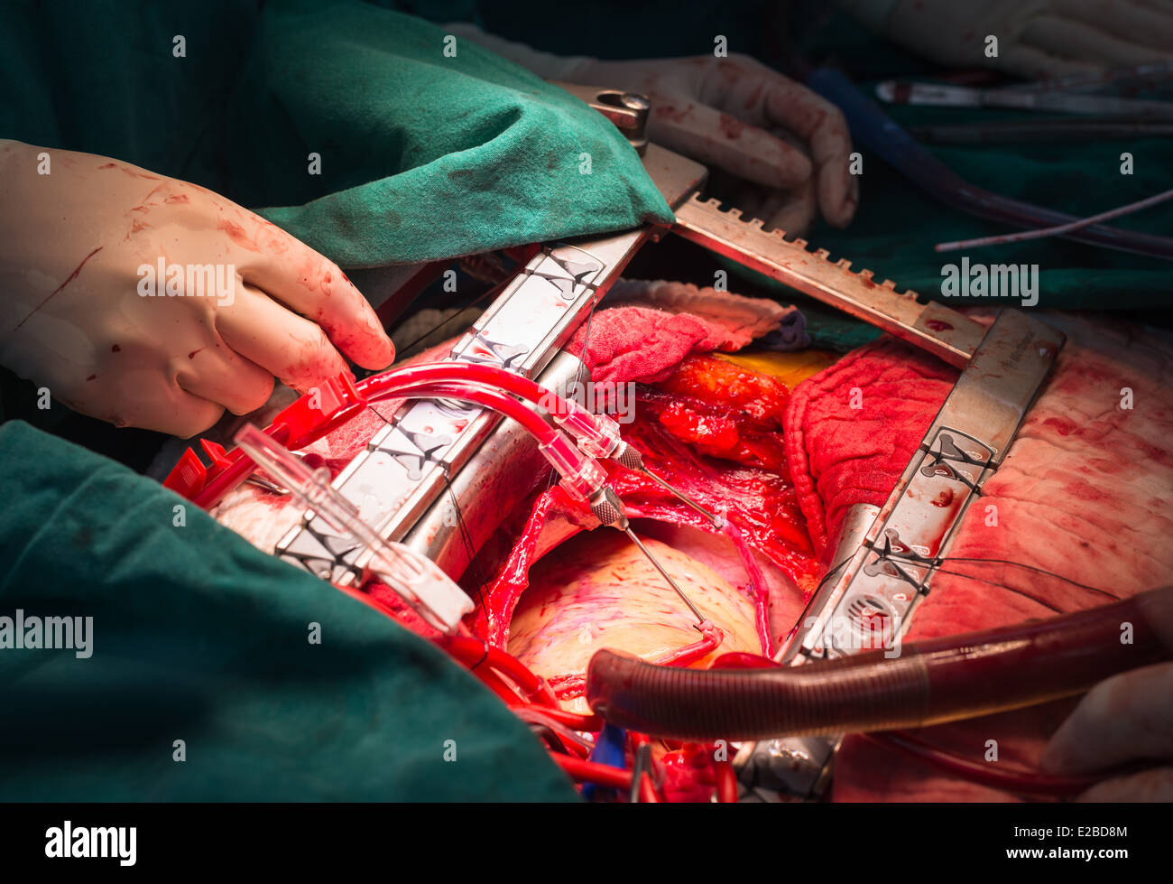Direkte Blut Kardioplegie über Leitung Stockfoto