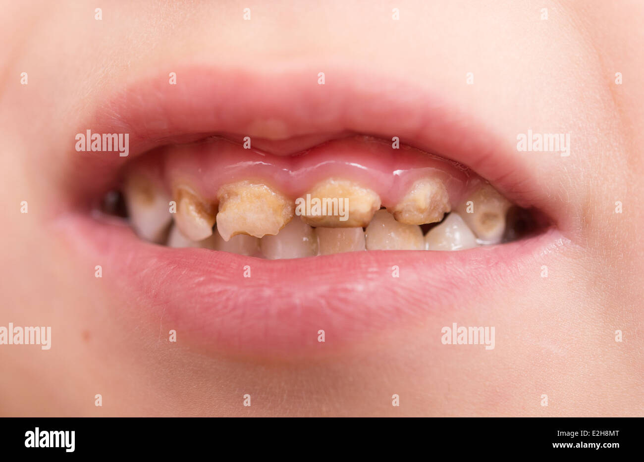Mit 30 zähne schlechte Schlechte Zähne: