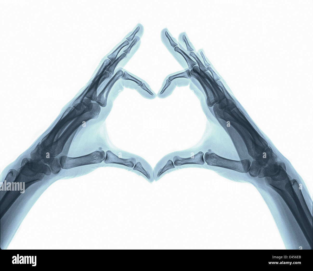 Röntgenaufnahme der Hände und Finger in Form von Herzen Stockfoto