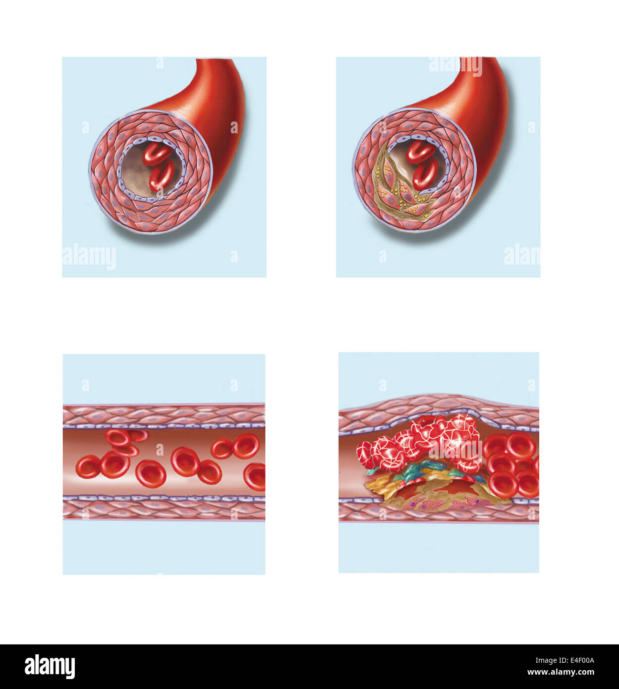 Normale Arterie im Vergleich zu Plaque und Thrombus-Bildung in Arterie. Stockfoto