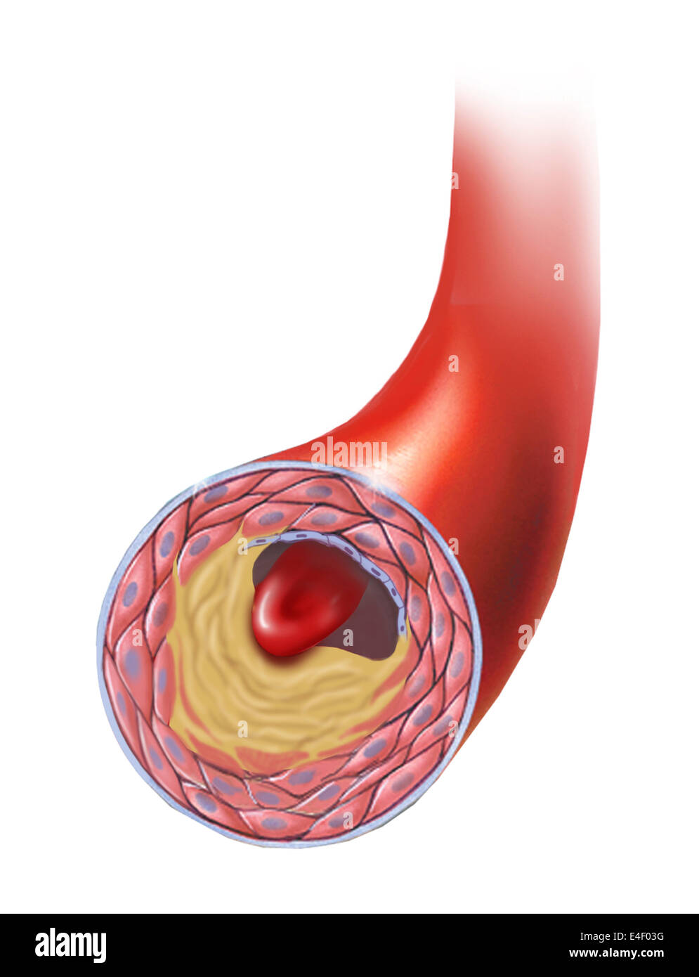 Aufbau von atherosklerotischen Plaque in einer Arterie. Stockfoto