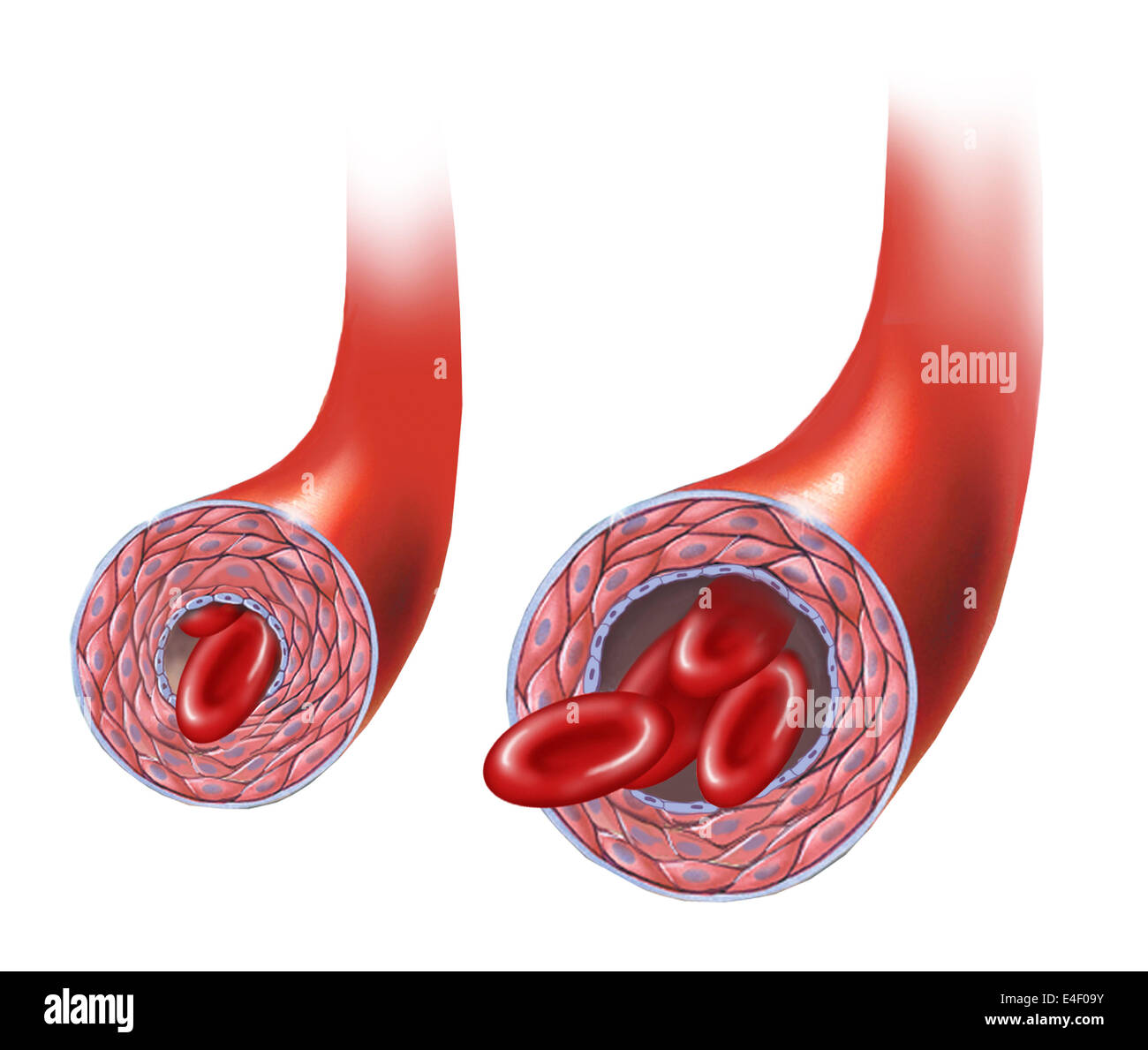 Normale Arterie versus Arterie im Krampf. Stockfoto