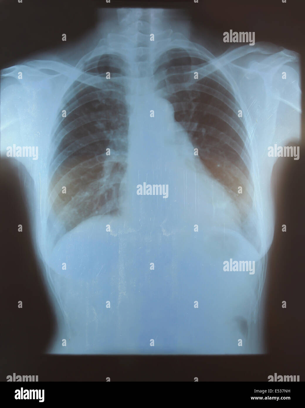 Röntgen-Bild der menschlichen Brust für eine medizinische Diagnose Stockfoto