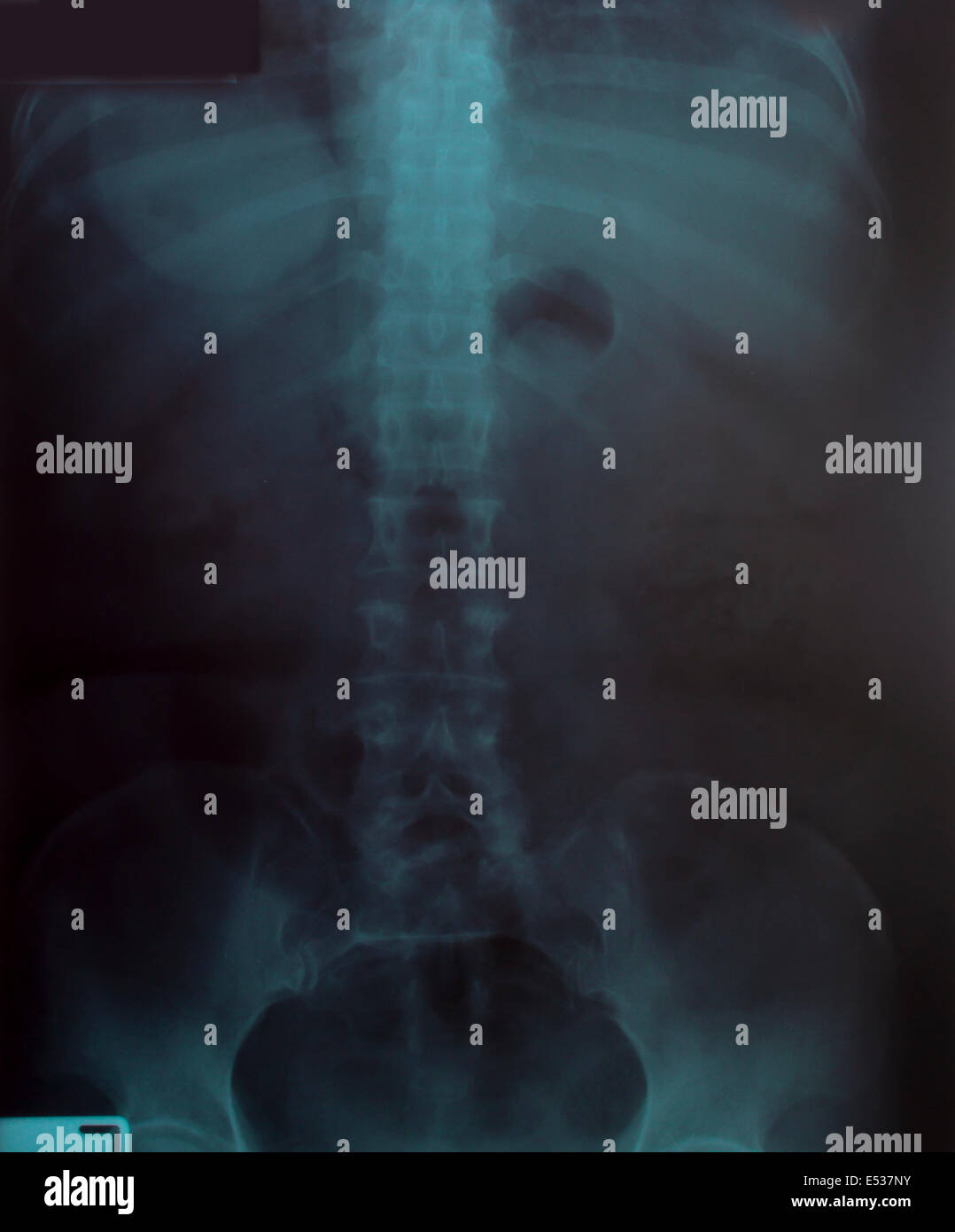 X-ray Image Of Human für eine medizinische Diagnose Stockfoto