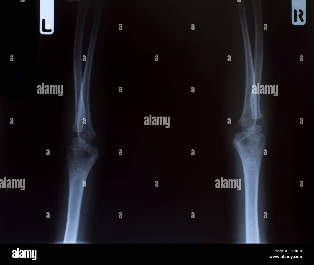 Röntgen-Bild der menschlichen Brust für eine medizinische Diagnose Stockfoto