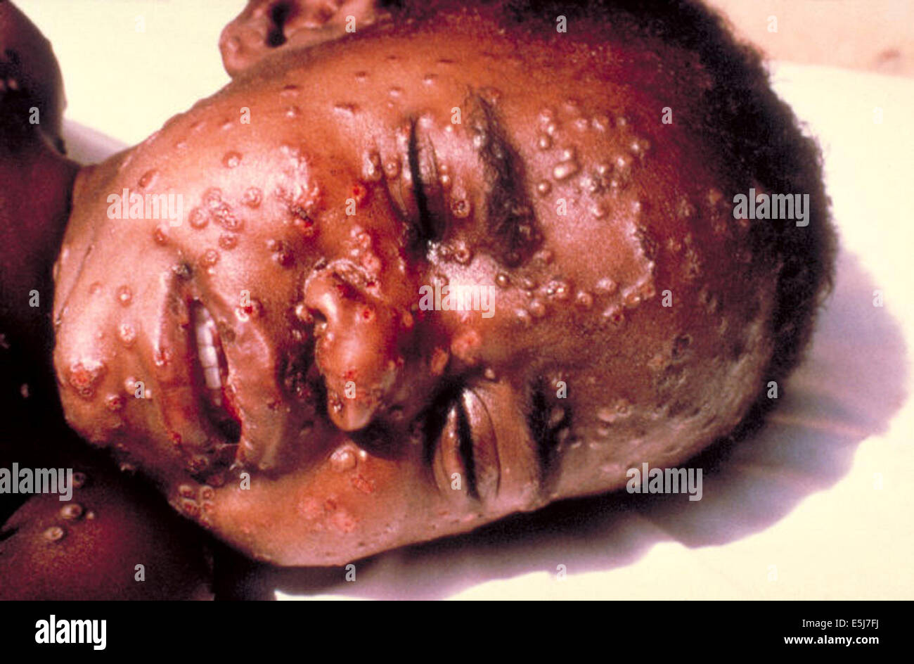 Ein Opfer des Pocken Variola Virus. Aus dem Archiv des Pressedienstes Portrait. NUR ZUR REDAKTIONELLEN VERWENDUNG Stockfoto