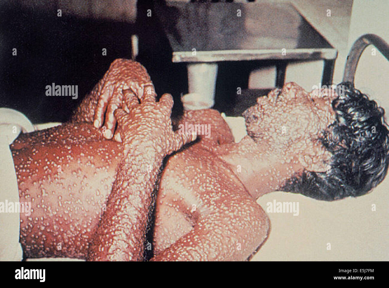 Ein Opfer des Pocken Variola Virus. Aus dem Archiv des Pressedienstes Portrait. Stockfoto