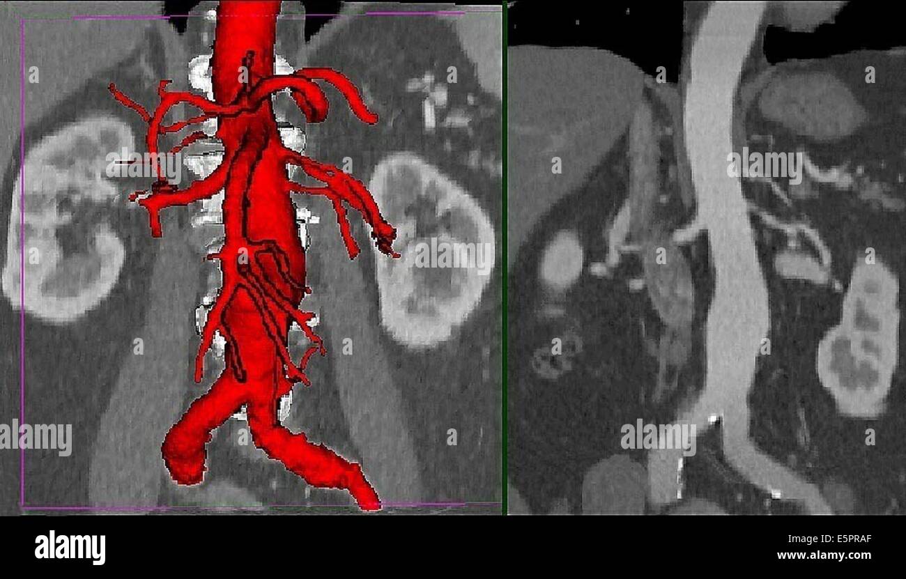 Dreidimensionale berechnete computertomographischen (CT) Scan Rekonstruktion einer abdominalen Aortenaneurysma, erscheint es als geschwollene Beule Stockfoto