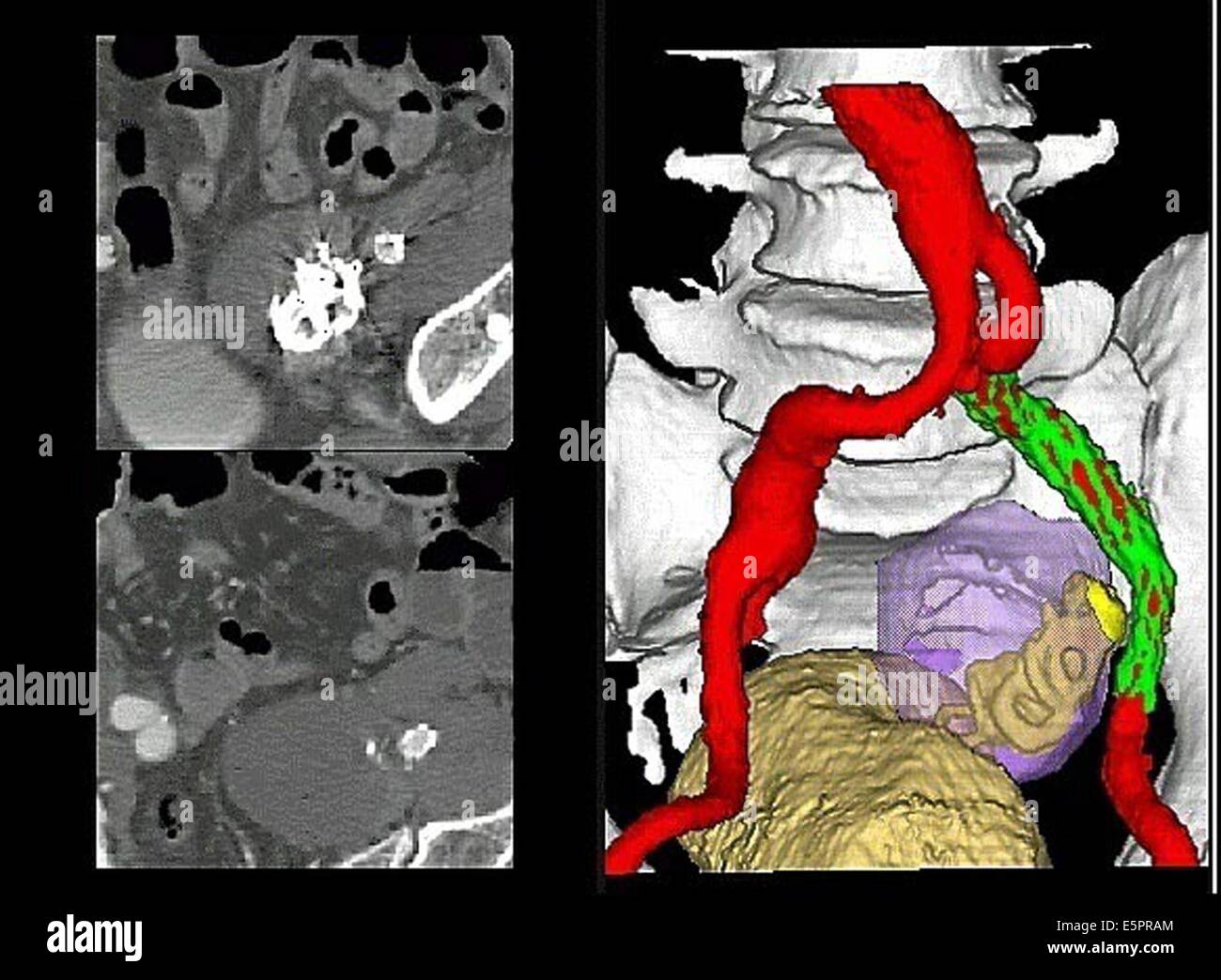 3D berechnet computertomographischen (CT)-Bild-Ansicht der internen ...
