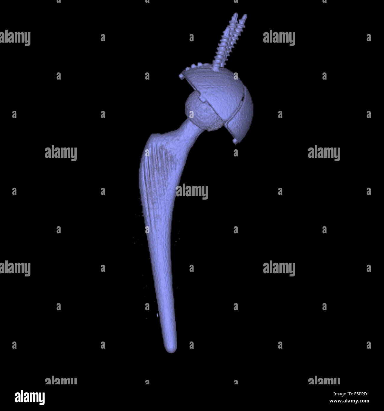 3D berechnet computertomographischen (CT) Scan Rekonstruktion einer Kugel-Buchse Prothese verwendet, um das alte Hüftgelenk ersetzen. Stockfoto