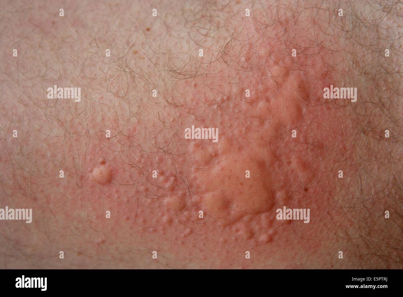 Urtikaria, Hautausschlag, auch bekannt als Nessel Hautausschlag oder Nesselsucht, verursacht durch eine Lebensmittelallergie ausgelöst durch Getreide. Stockfoto