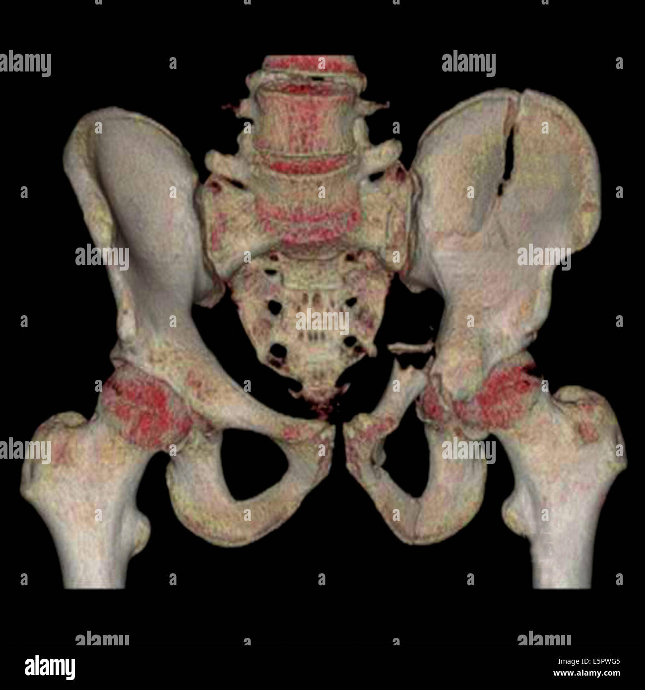 3D-Scan berechnet computertomographischen (CT) Rekonstruktion des Beckens zeigt einen gebrochenen linken Beckenkamm Flügel (rechts) und einem gebrochenen Stockfoto