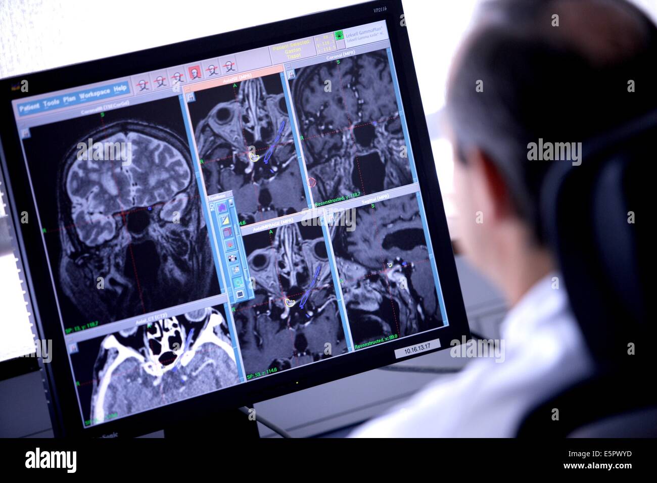 Behandlung von ein Meningeom (gutartiger Hirntumor) mit einer Gamma-Knife, hier, medizinische Bildgebung (MRT und CT-Scans) Daten zusammengestellt Stockfoto