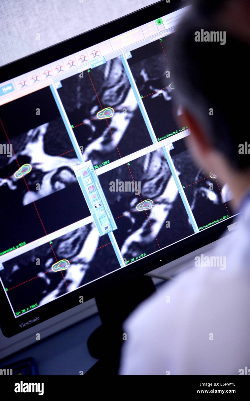 Behandlung von ein Meningeom (gutartiger Hirntumor) mit einer Gamma-Knife, hier, medizinische Bildgebung (MRT und CT-Scans) Daten zusammengestellt Stockfoto