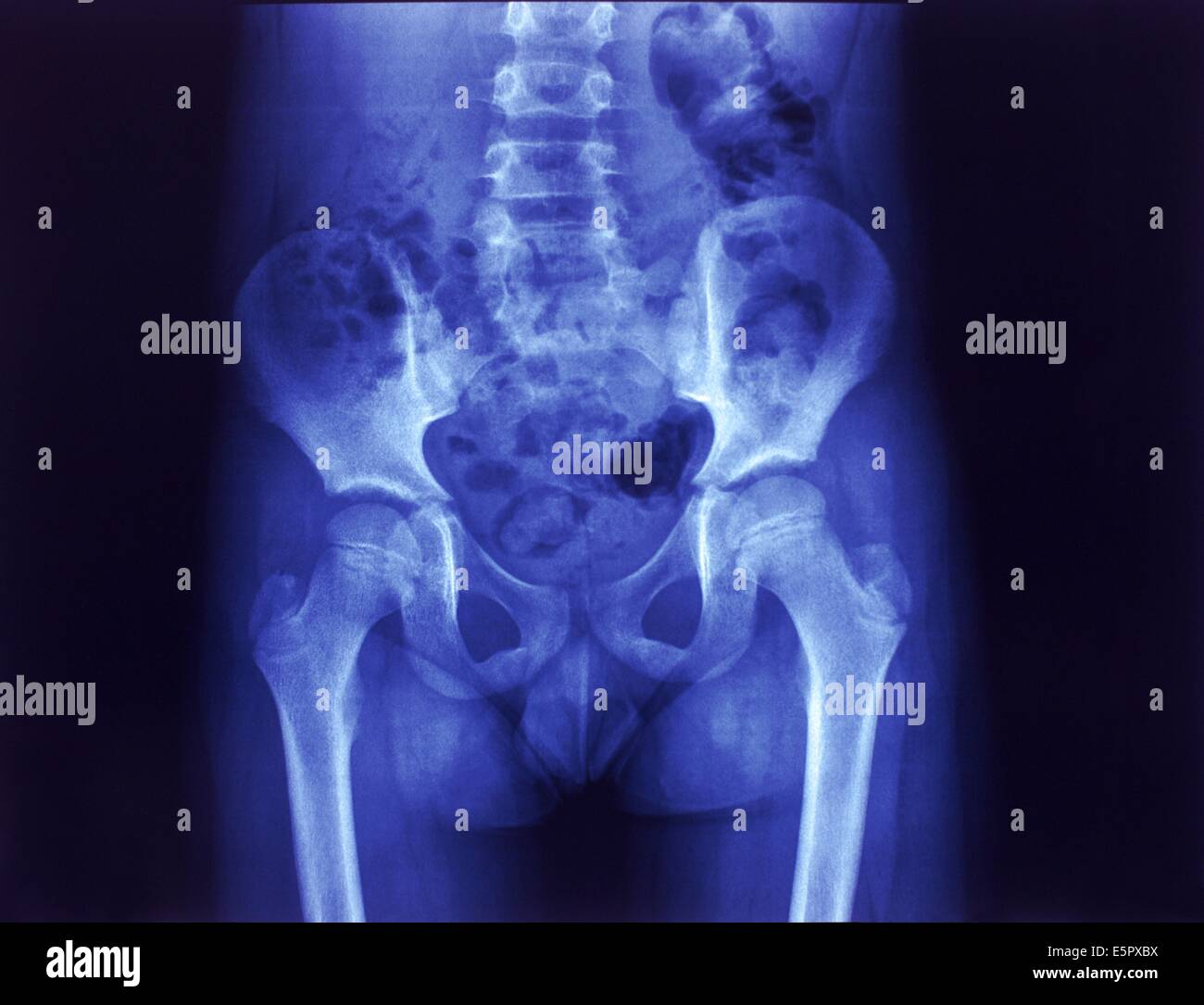 X-ray ein normales Becken eines Kindes Stockfotografie - Alamy