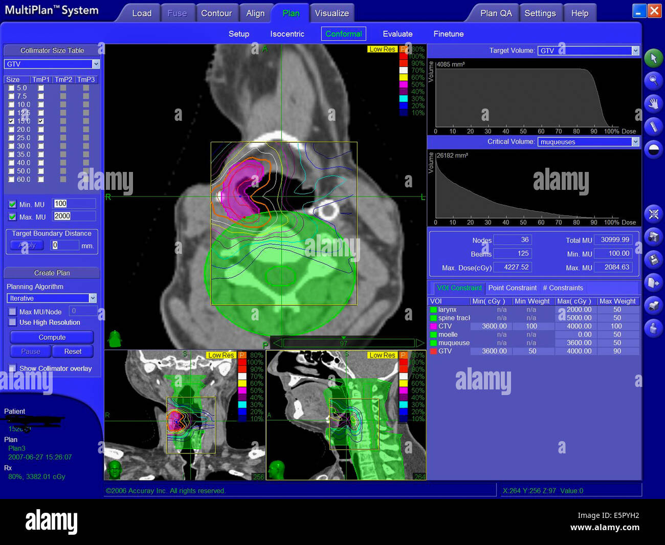 Behandlung von Krebserkrankungen von robotisierten Strahlentherapie, ermöglicht diese Atmung angepasst Strahlentherapie den Tumor mehr ausrichten Stockfoto