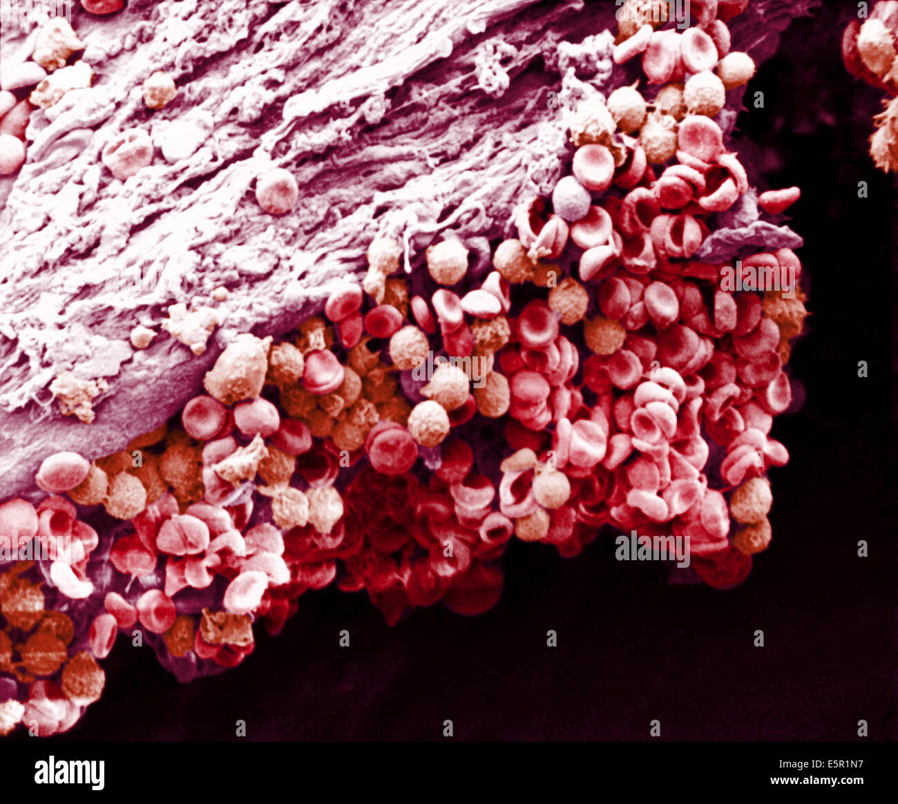 Scanning Electron Schliffbild (SEM) verklumpte rote und weiße Blutkörperchen in einem Blutgefäß. Stockfoto