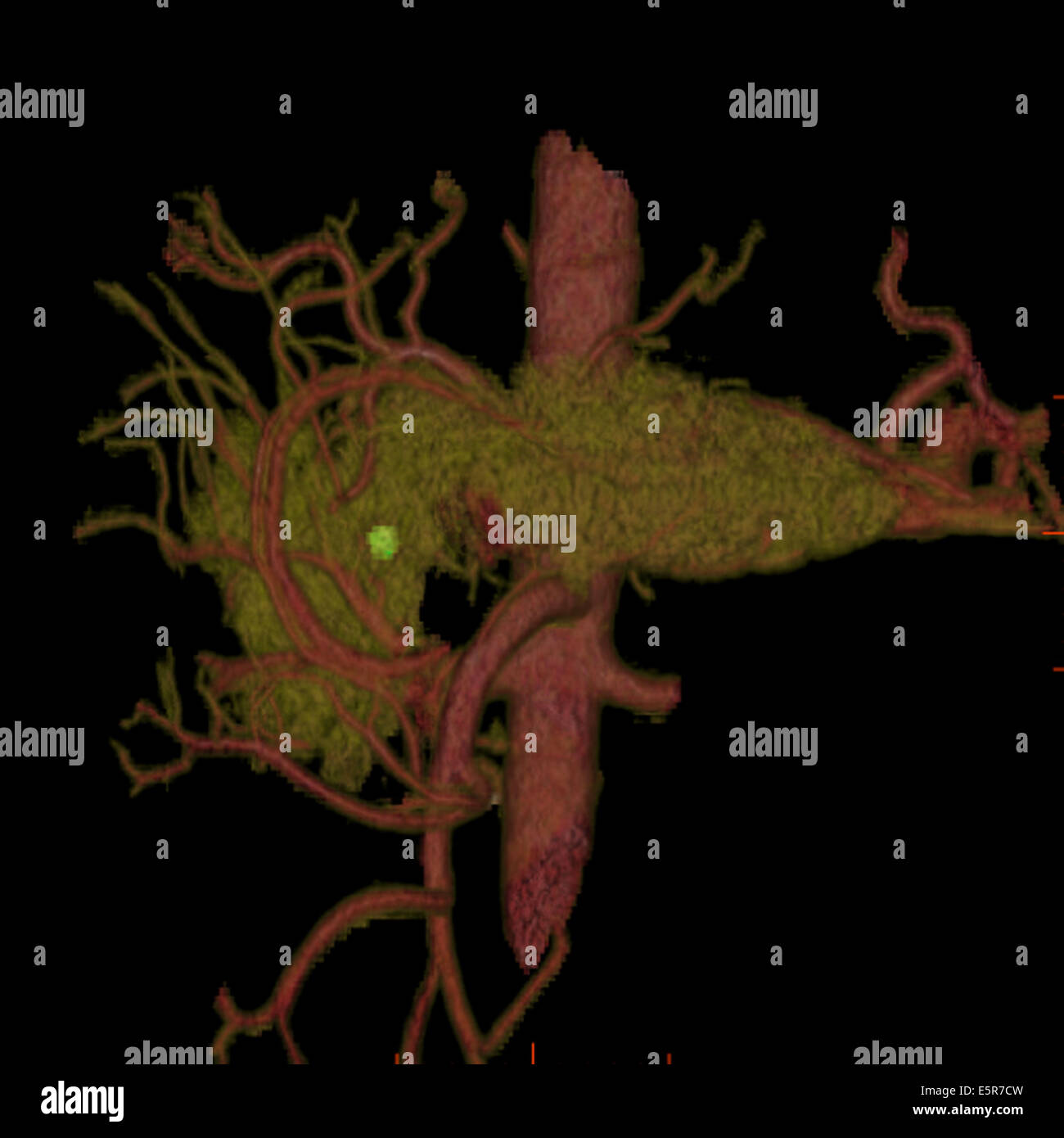 Dreidimensionale berechnete tomographische Rekonstruktion Scannen der Bauchspeicheldrüse zeigt einen Tumor (grün). Stockfoto
