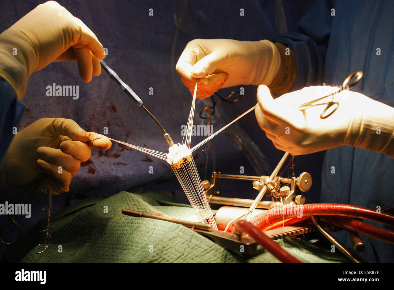Mitralklappe-TEP, eine Operation am offenen Herzen erfordert einen Herz-Lungen-Bypass, Brust- und Herz-und Gefäßchirurgie Stockfoto