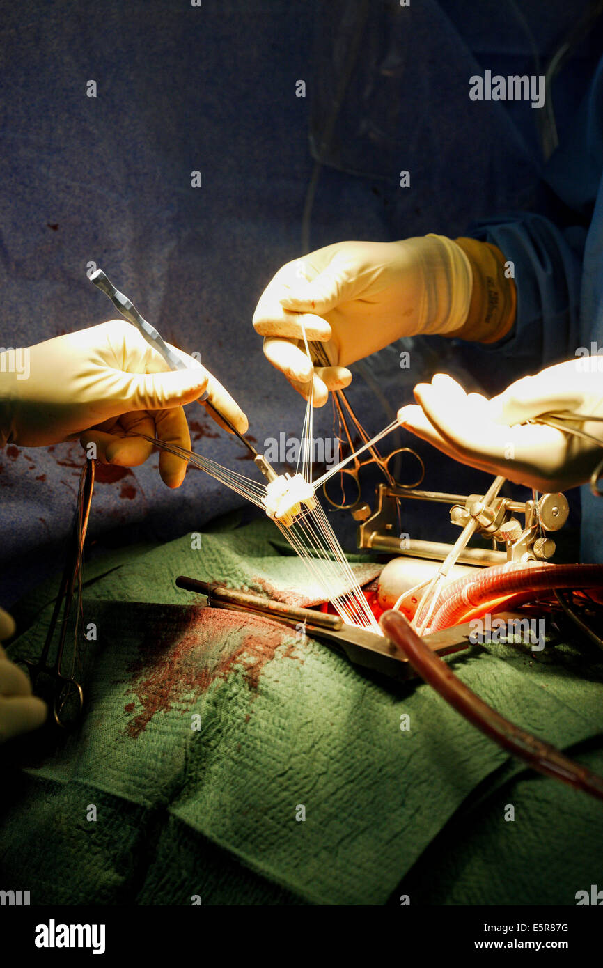 Mitralklappe-TEP, eine Operation am offenen Herzen erfordert einen Herz-Lungen-Bypass, Brust- und Herz-und Gefäßchirurgie Stockfoto