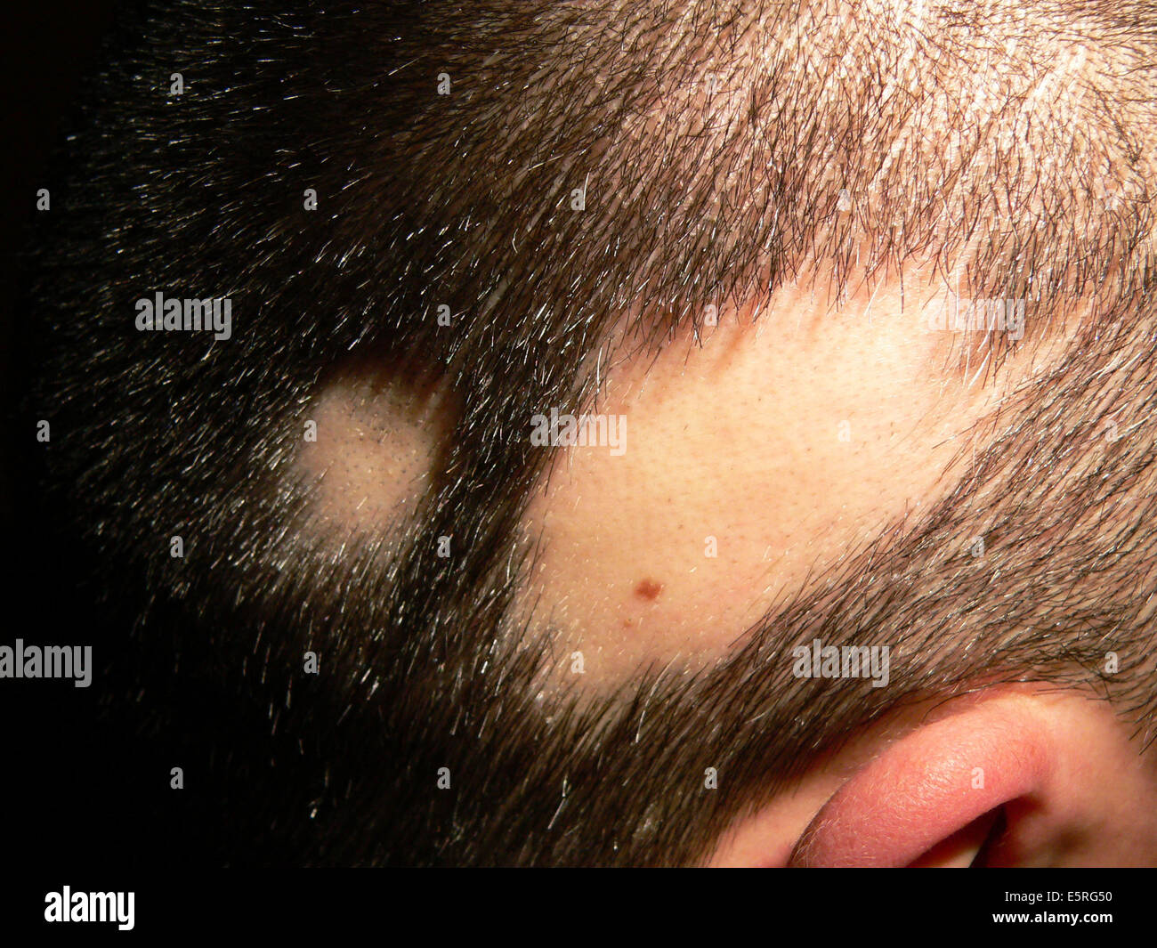 Kahle Stelle auf der Kopfhaut eines Kindes aufgrund von Alopecia Areata. Stockfoto